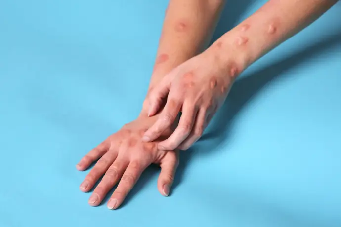 Mpox, viruela del mono