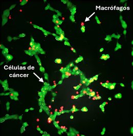 Microscopia eletrônica de células cancerígenas de neuroblastoma tratadas inicialmente com lipossomas e posteriormente com macrófagos modificados com lipossomas.