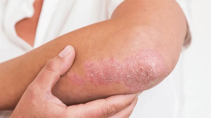 Imagen de psoriasis en la piel.