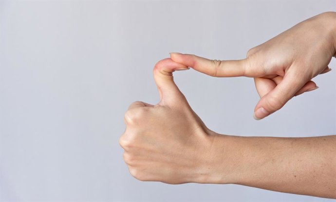 Archivo - Arquivo - Dedos hiperflexíveis, hiperlaxidade.