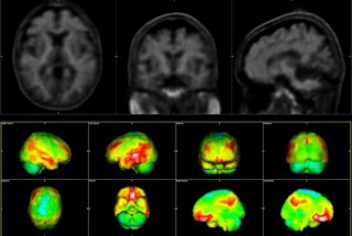 Hallazgos de la PET en la enfermedad de Alzheimer: PET con amiloide en un paciente anciano con síntomas de EA.