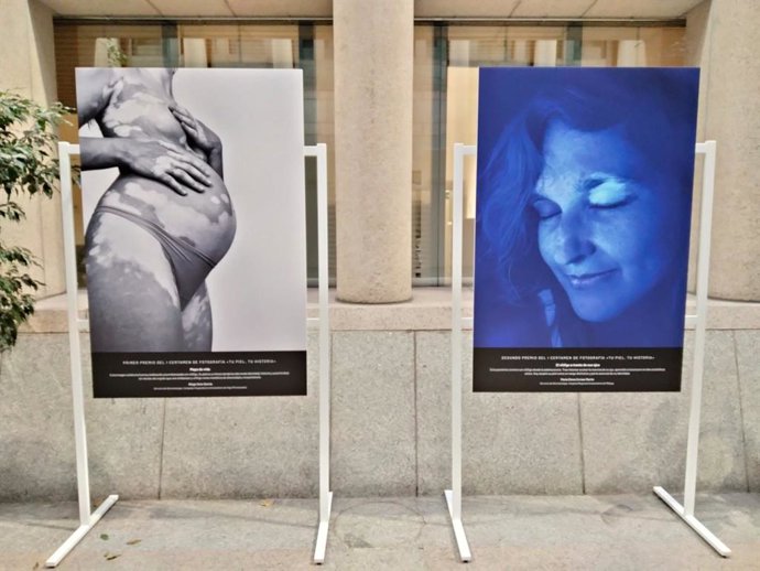 A primeira exposição fotográfica sobre vitiligo no Senado.