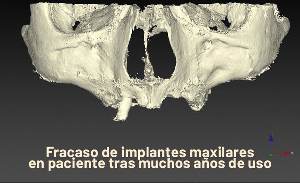 Un cirujano de Vithas Medimar lidera un estudio que avala el Quad Zygoma como "solución" a implantes maxilares fallidos