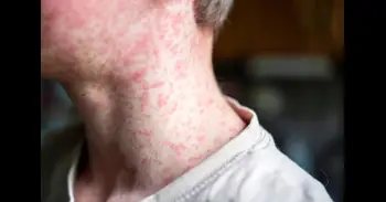 Sanidad confirma 16 positivos de sarampión en dos empresas de Alicante que están en un mismo edificio