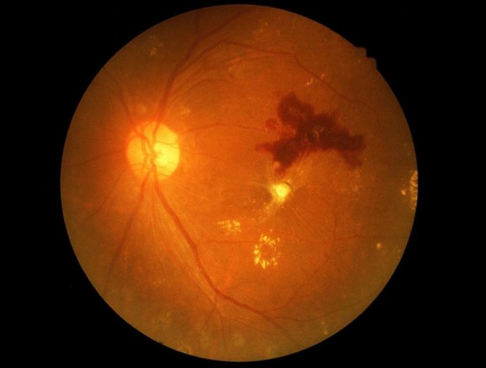 Archivo - Imagen de recurso de retinopatía diabética.