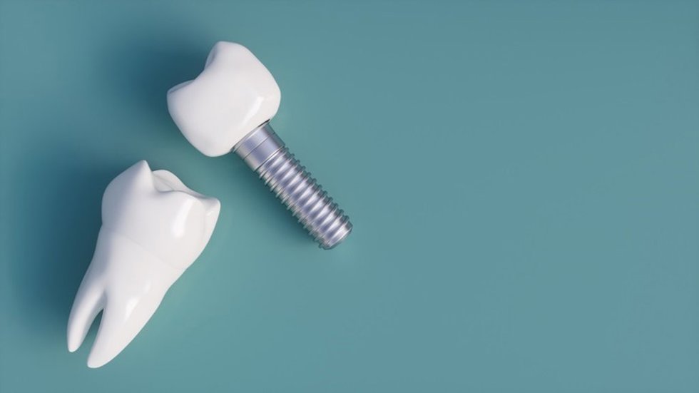 Archivo - Implante dental.-ARCHIVO