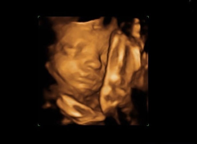 Archivo - Ecografía