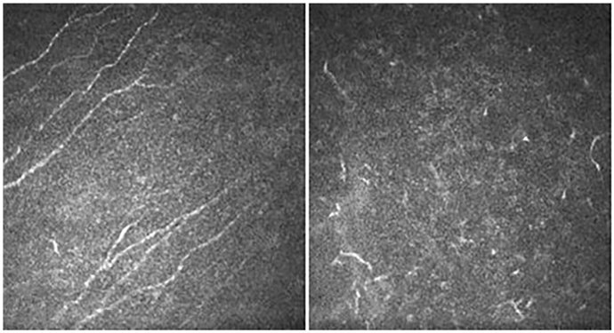 Córnea de un ojo sano (izquierda) y de un paciente con aniridia (derecha), mostrando cambios en las células defensivas del tejido que reflejan la alteración de la córnea.