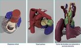 Foto: Empresas.- La Fundación Jiménez Díaz destaca la precisión y eficacia de la cirugía cardiaca guiada por modelos 3D