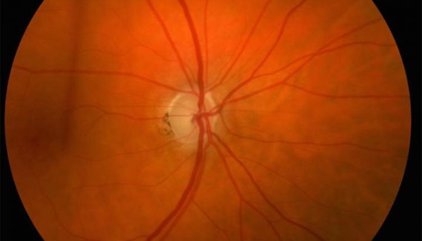 Los 'equipo de limpieza' del ojo: descubren células inmunes clave para controlar la presión ocular y frenar el glaucoma