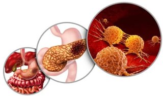 Esquema del cáncer de páncreas y de los inhibidores duales.