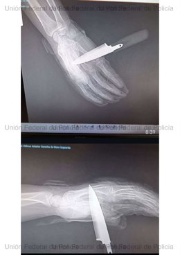Radiografía de la mano del agente de la Policía Nacional apuñalado en Baza (Granada)