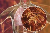 Foto: Europa no detecta uno de cada cinco casos de tuberculosis