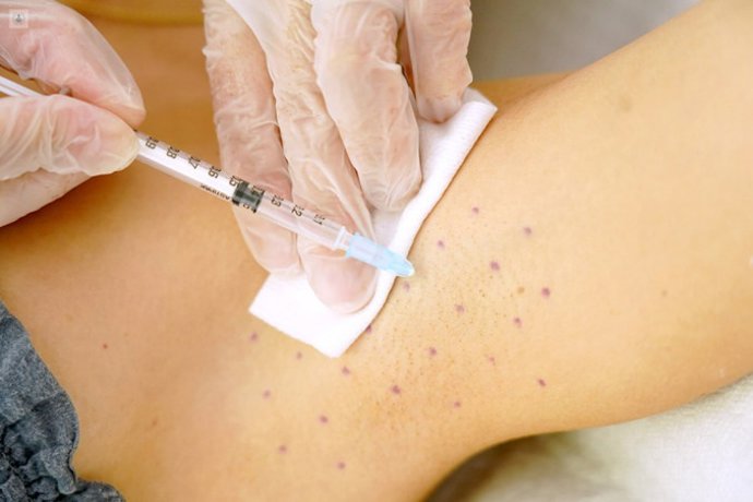 Microinjeções de toxina botulínica para tratar a hiperidrose.