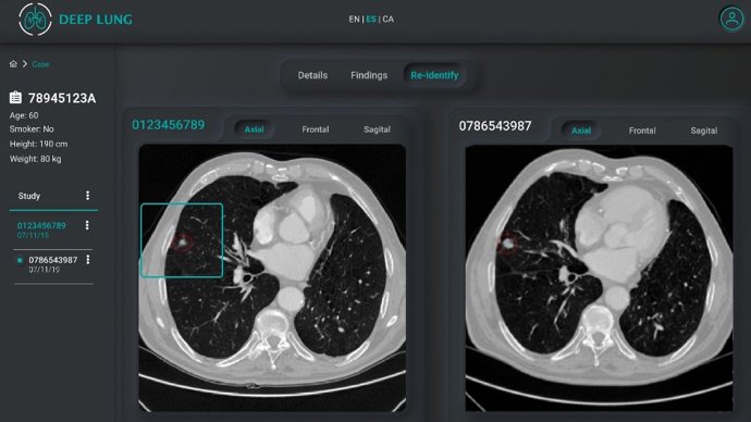 Detalle del proyecto Deep Lung para el desarrollo de una herramienta de inteligencia artificial aplicada a las imágenes de Tomografía Computarizada para detectar precozmente el cáncer de pulmón