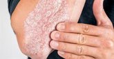 Foto: Por qué la psoriasis siempre vuelve al mismo sitio: el descubrimiento sobre la 'memoria' de la piel