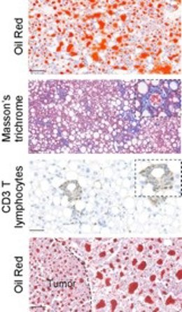 Remodelado hepático y progresión de la enfermedad en modelos de hígado graso - Imágenes adaptadas de Belloc et al., 'Science Advances' (2026).
