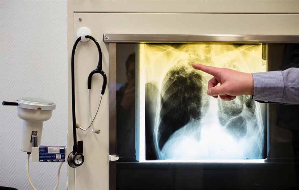Archivo - FILED - 23 February 2016, Berlin: A doctor shows a tuberculosis case using an X-ray in his office at the tuberculosis center. Photo: Gregor Fischer/Deutsche Presse-Agentur GmbH/dpa