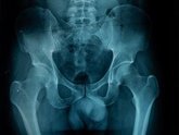 Foto: El uso prolongado de corticoides y las fracturas previas determinan el desarrollo de la osteoporosis, según reumatóloga