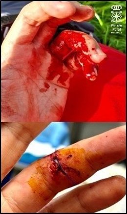 Imagen de las heridas sufridas por el agente.