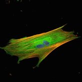Foto: Identifican un biomarcador para determinar si la inmunoterapia puede funcionar en cáncer colorrectal