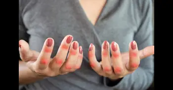 Las enfermedades autoinmunes podrían tener un origen genético oculto en las células inmunitarias