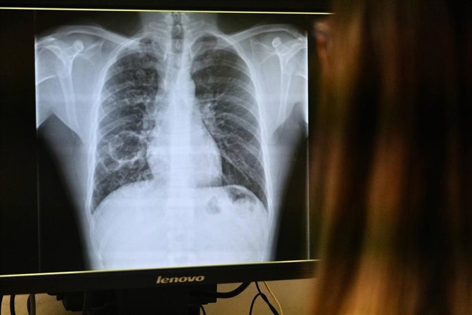 Radiografía de tuberculosis