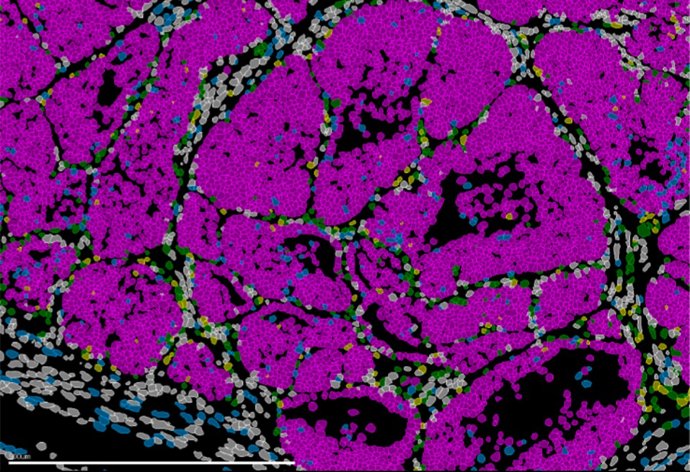 Imagen de un tumor de mama en ratón que muestra las distintas poblaciones celulares (células cancerosas en rosa). Tecnologías avanzadas de biología espacial permiten la identificación simultánea de todos los tipos celulares presentes en el tejido.