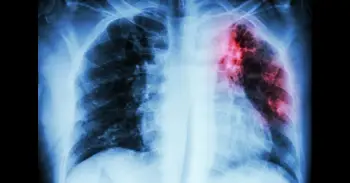 Una terapia génica que edita el ADN logra corregir en laboratorio una mutación de fibrosis quística sin tratamiento