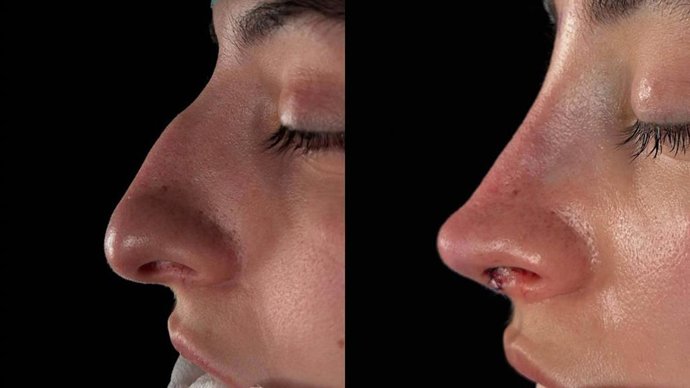 Miedo a la rinoplastia; la barrera emocional de no reconocerse tras la cirugía