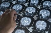 Foto: En la enfermedad de Alzheimer, las mutaciones cancerosas se acumulan en las células inmunitarias del cerebro