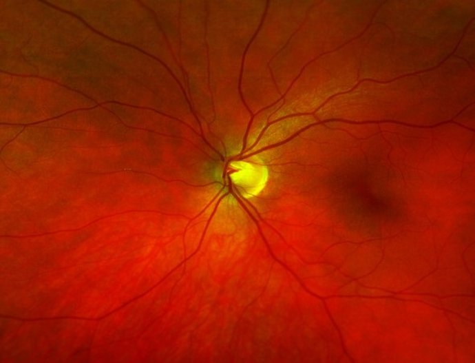 Archivo - Closeup image of the disc and optic nerve