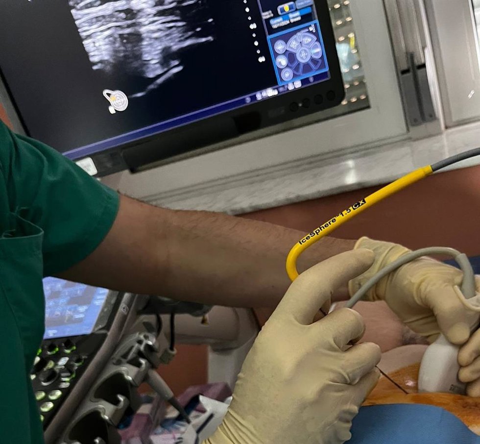 Técnica de crioablación en el Hospital de La Candelaria (Tenerife)