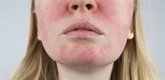 Foto: Empresas.- Anifrolumab (AstraZeneca) una mejora la enfermedad del lupus en pacientes con tratamiento temprano