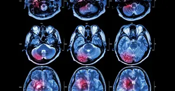 Un estudio pone el foco en la testosterona y su posible papel en el cáncer cerebral en hombres