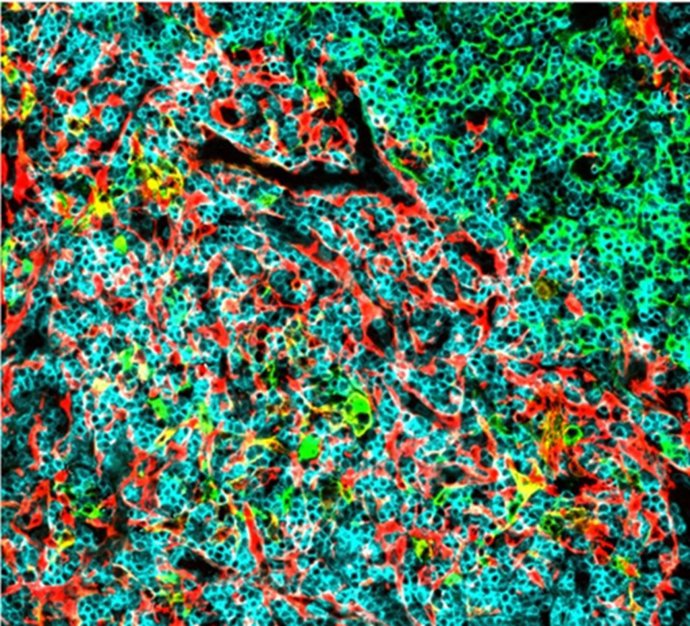 Identifican dos moléculas del organismo que podrían ayudar a frenar el crecimiento de un tipo de leucemia muy agresiva