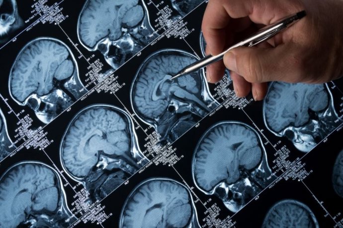 Archivo - Imagen de recurso de un cerebro.