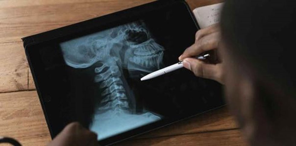 La Universidad de Deusto participa en una IA que predice la calidad de vida de supervivientes de cáncer de cabeza y cuello.