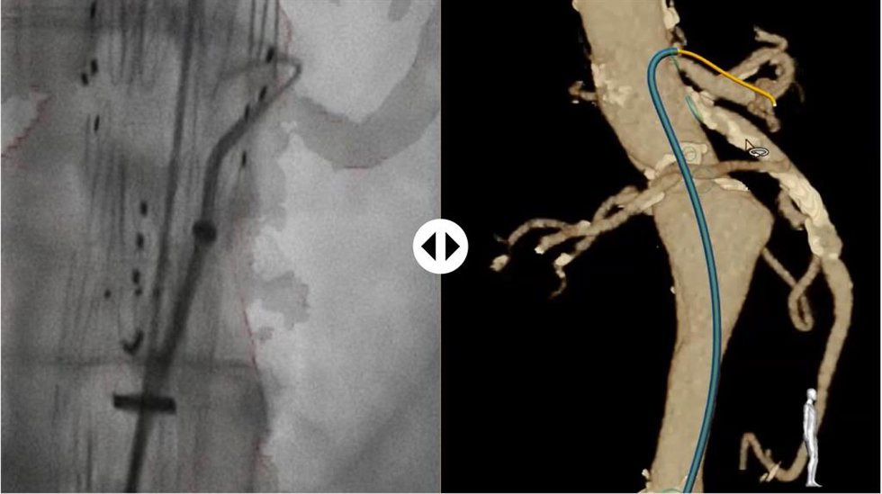 Imagen de navegación endovascular con el sistema LumiGuide de Philips