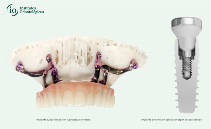Institutos Odontológicos incorpora el tratamiento con implantes subperiósticos para mejorar la calidad de vida de pacientes que solo podían optar a prótesis removibles