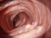 Foto: Tu pólipo ya no está, pero el riesgo de cáncer de colon sigue: científicos apuntan al microbioma y esta es la solución
