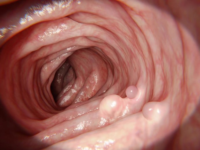 Archivo - Pólipos intestinales