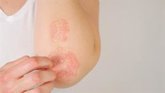Foto: Ni más dosis ni más pinchazos: el hallazgo que puede cambiar el tratamiento de la psoriasis