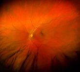 Foto: La detección temprana es clave para evitar la ceguera irreversible por edema macular diabético