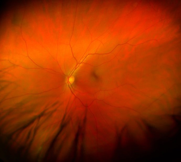 Archivo - Edema macular.