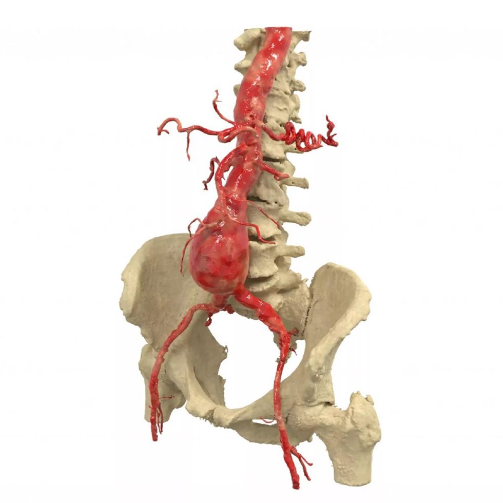 Ivace+i financia una herramienta asistida por IA para anticipar el riesgo de rotura de aneurismas de aorta abdominal.