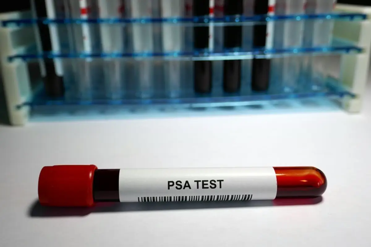 Prueba de detección de cáncer de próstata