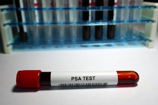 Archivo - Prueba de detección de cáncer de próstata.