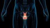 Foto: El varicocele afecta a alrededor del 15% de los hombres y puede causar infertilidad