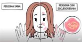 Foto: Una reumatóloga destaca que el diagnóstico precoz y las nuevas terapias están cambiando el pronóstico de esclerodermia